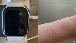 Apple Watch SE gặp lỗi quá nhiệt, khiến người dùng bị bỏng và làm hỏng màn hình